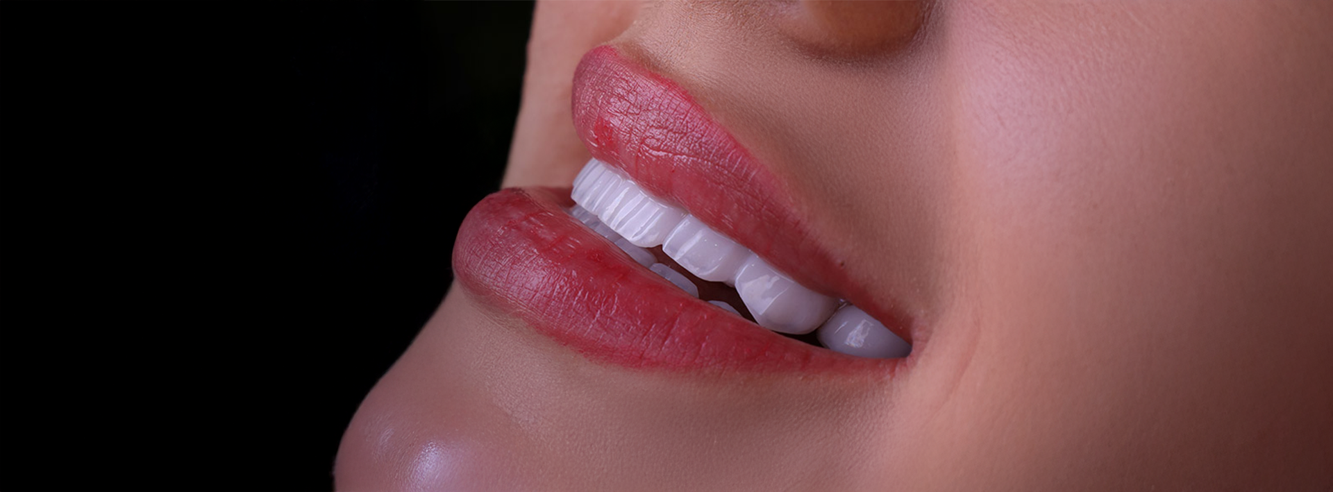 Karisma Zircon Elite Hollywood smile