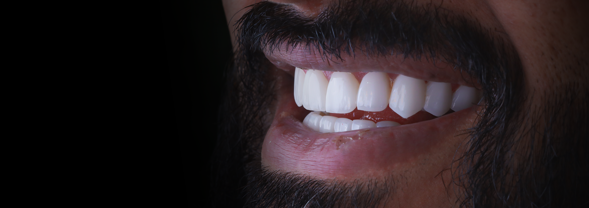 Diamond Cut Smile