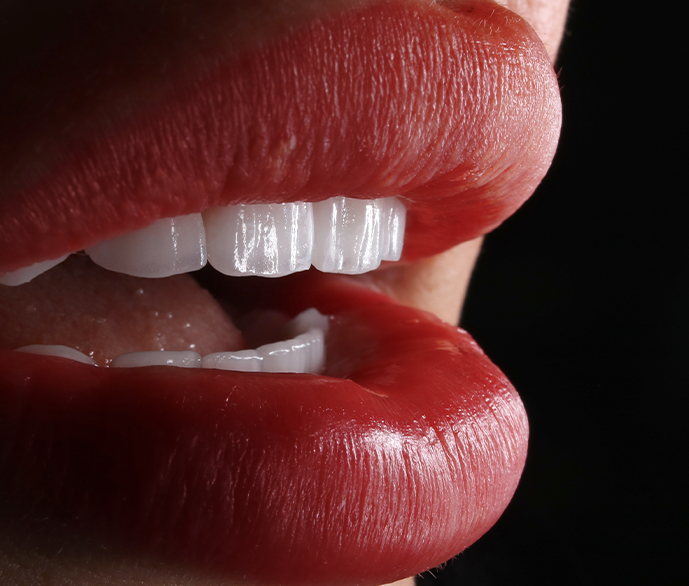 Hollywood Smile (Veneers)