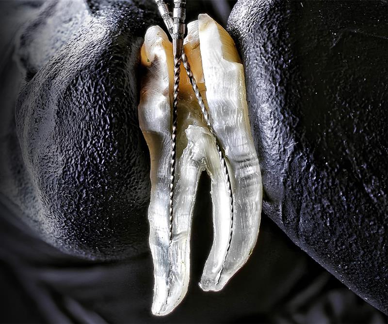 Root Canal Treatment