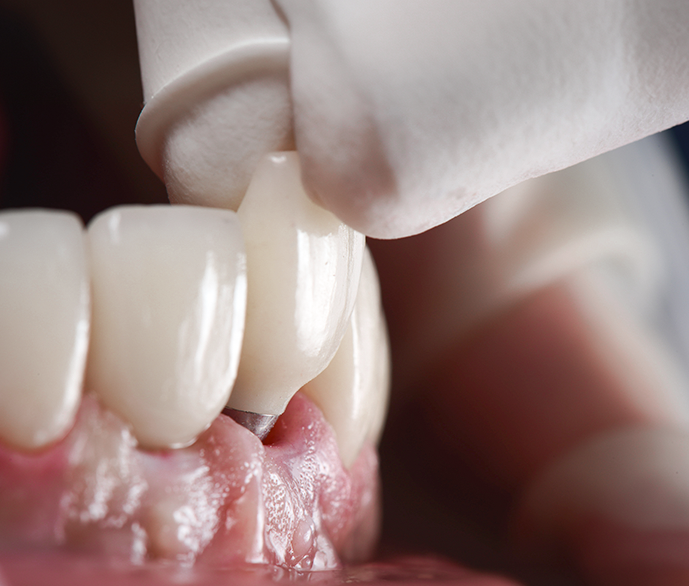 Implant