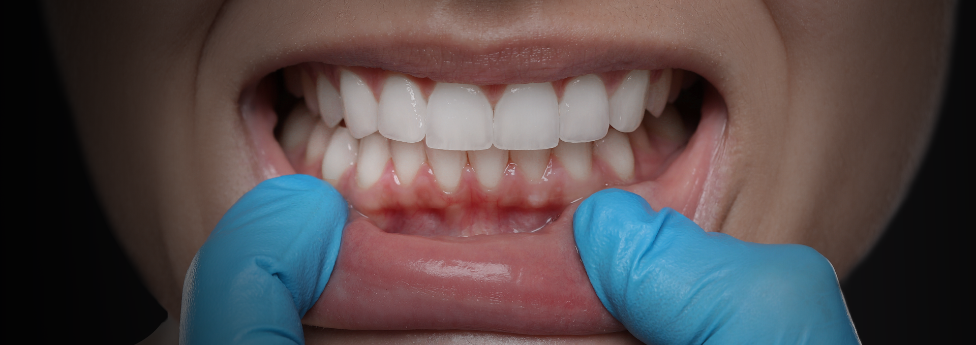 Oral health (Gum treatment)